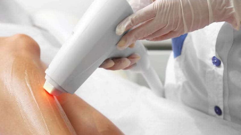 What is Laser Hair Removal